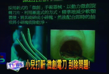小兒打鼾 微創電刀 刮除問題!
