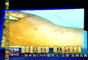 鋤草遭火蟻攻擊 婦人急性腎衰竭