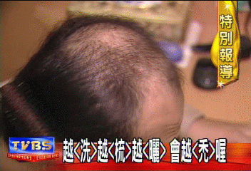 秋冬落葉也落髮　防禿有撇步