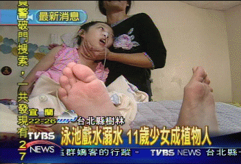 泳池戲水溺水 11歲少女成植物人