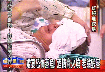 婚宴恐怖蒸魚!酒精膏火燒 老翁毀容