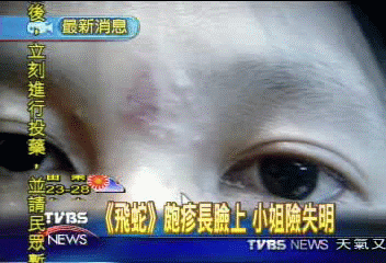 「飛蛇」皰疹長臉上 小姐險失明