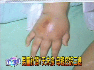 男童針頭7天未換　母親控訴三總