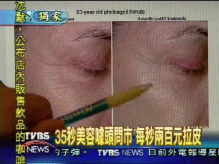 〈獨家〉35秒6千元 超貴除皺術 鎖定台灣貴婦
