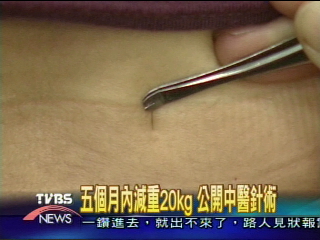 穴位埋針加薰臍 5個月甩20公斤