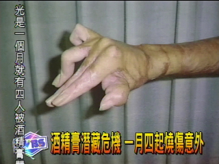 酒精膏潛藏危機 一月四起燒傷意外