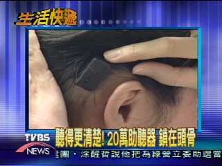 聽得更清楚!20萬助聽器 鎖在頭骨