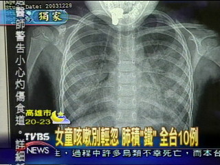 〈獨家〉罕見鐵肺人　肺部鐵化插管度日