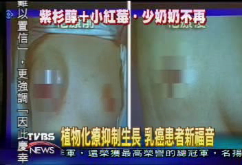 術前化療　乳癌患者不必「少奶奶」