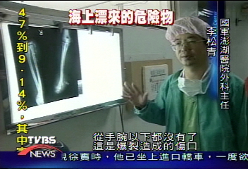 撈到炸魚彈!轟一聲 漁民斷掌濺血
