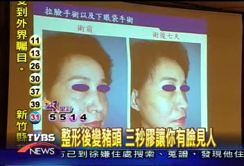 整形後變豬頭　三秒膠讓你有臉見人