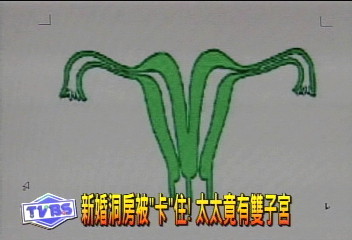 新婚洞房被「卡」住! 太太竟有雙子宮