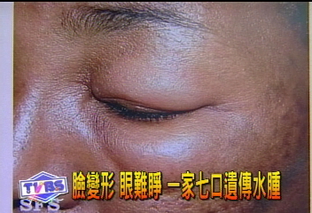 臉變形　眼難睜　一家7口遺傳水腫