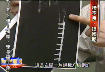 玩公園搖椅腳被夾 男童大腿骨折斷