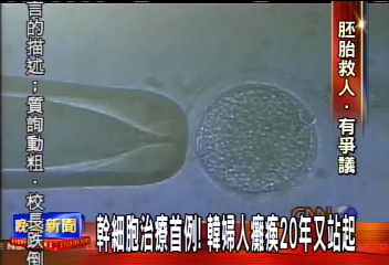 幹細胞治療成功！南韓婦女恢復行走