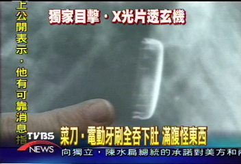 〈獨家〉吞下滿腹怪東西 X光片獨家目擊