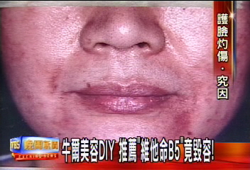〈獨家〉牛爾推薦DIY廠商　「維他命B5」竟毀容！