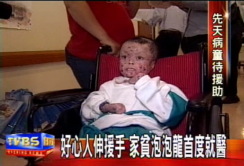 搶救「泡泡龍」　水泡纏身　手腳萎縮