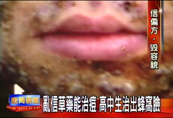 敷草藥偏方戰痘 少男反成蜂窩臉