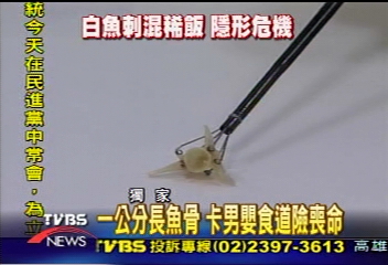 〈獨家〉1公分長魚骨 卡男嬰食道險喪命