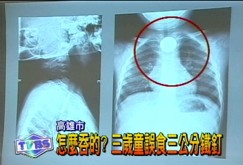 怎麼吞的?3歲童誤食3公分鐵釘