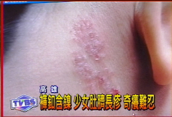 褲扣含鎳　少女肚臍長疹　奇癢難忍