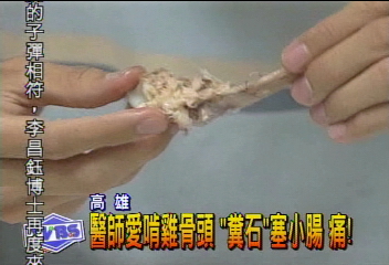 醫師愛啃雞骨頭 「糞石」塞小腸 痛!