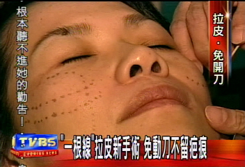 姊弟戀被甩　熟女拉皮「線」變臉