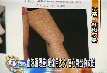 〈獨家〉不是流行！暖爐用太久　熱出豹紋斑！