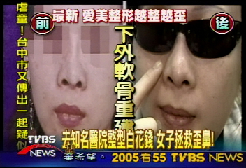 〈獨家〉醫學中心整型　辣妹鼻孔一大一小！