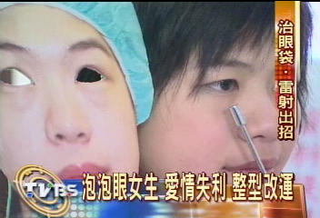 泡泡眼女生 愛情失利 整型改運