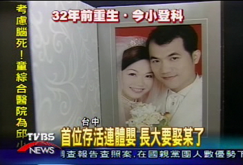 首位存活連體嬰 長大要娶某了
