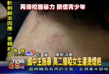 國中生圍毆! 高二瘖啞女生遭燙煙疤