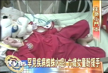 罕見疾病蜘蛛人症! 6歲女童盼援手