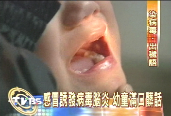 感冒誘發病毒腦炎 幼童滿口髒話