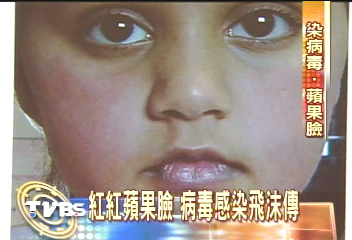 小兒可愛蘋果臉？　當心！病毒感染