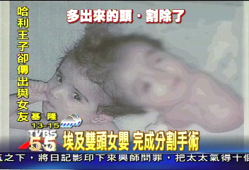 埃及雙頭女嬰 摘除「多出來」的頭