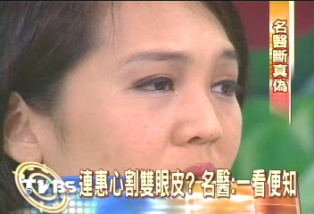 連惠心雙眼皮 整型界大老直斷