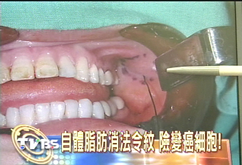 自體脂肪消法令紋 險變癌細胞!