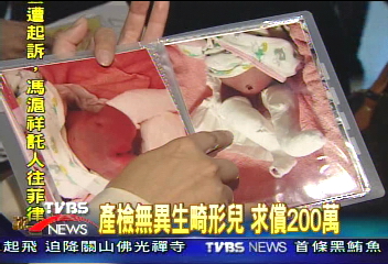 產檢無異生畸形兒　家屬求償200萬