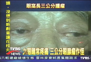 水汪汪大眼睛　小心眼腺瘤作怪