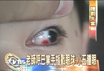 不寫作業代價大 老師掌摑傷眼球
