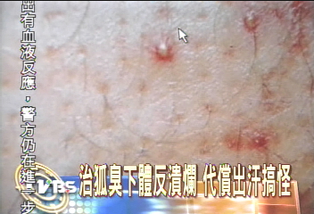 治狐臭下體反潰爛 代償出汗搞怪