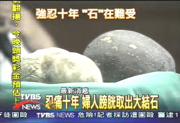 忍痛十年　婦人膀胱取出大結石