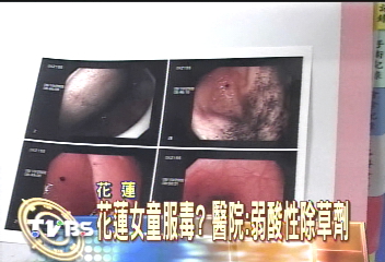 小一女童喝除草劑　疑母親逼的
