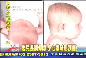 嬰兒長期仰睡 小心變畸形頭顱!