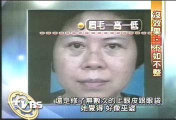 3年整形11次　65歲婦五官變形