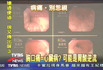 胸口痛=心臟病？　可能是胃酸逆流