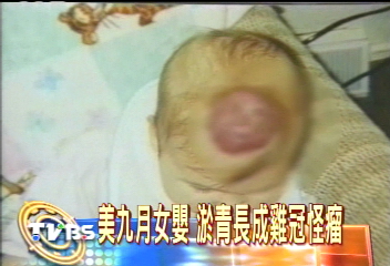 美9月女嬰 淤青長成雞冠怪瘤