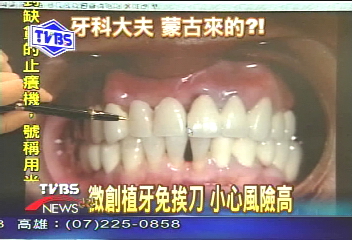 〈獨家〉花百萬換爛牙？　微創植牙得小心